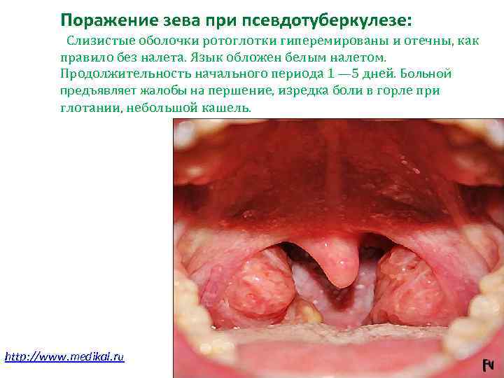  Поражение зева при псевдотуберкулезе: Слизистые оболочки ротоглотки гиперемированы и отечны, как правило без