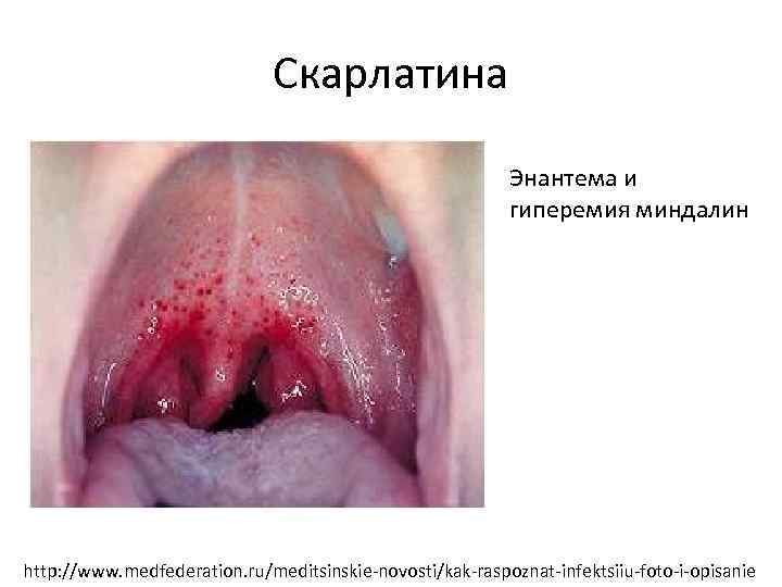  Скарлатина Энантема и гиперемия миндалин http: //www. medfederation. ru/meditsinskie-novosti/kak-raspoznat-infektsiiu-foto-i-opisanie 