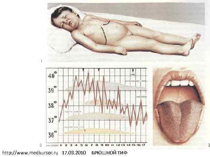 http: //www. medkursor. ru 17. 03. 2010 БРЮШНОЙ ТИФ 