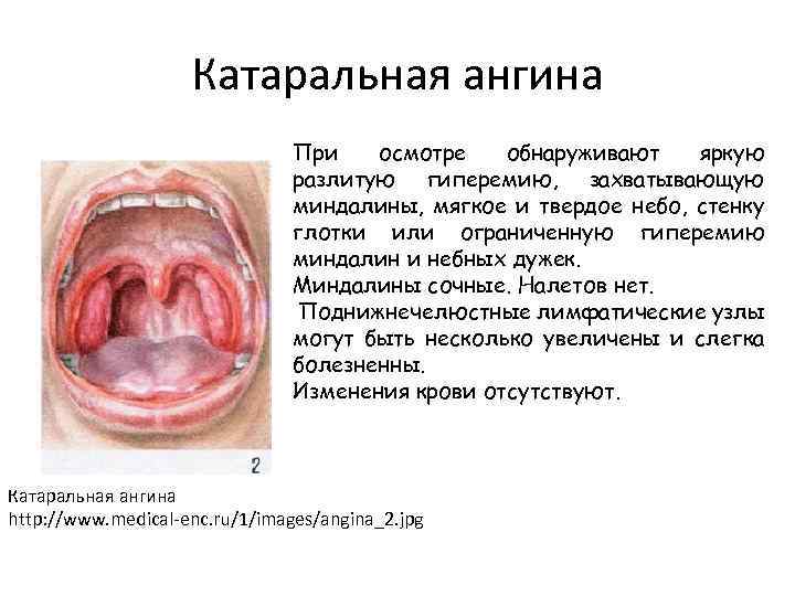 Как выглядит катаральная ангина фото