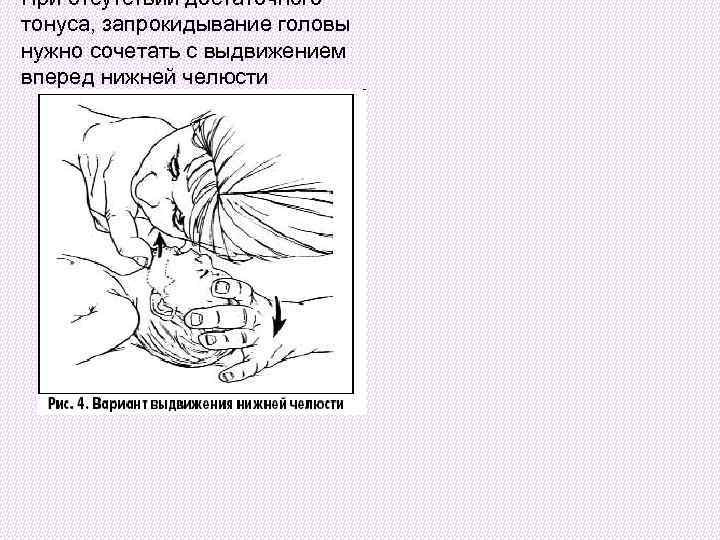 При отсутствии достаточного тонуса, запрокидывание головы нужно сочетать с выдвижением вперед нижней челюсти 