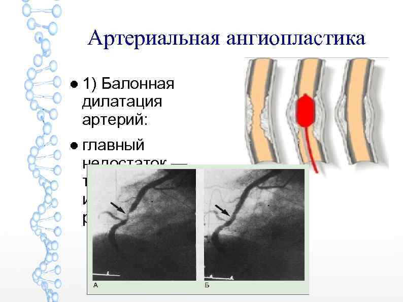 Артериальная ангиопластика ● 1) Балонная дилатация артерий: ● главный недостаток — травматизация интимы →