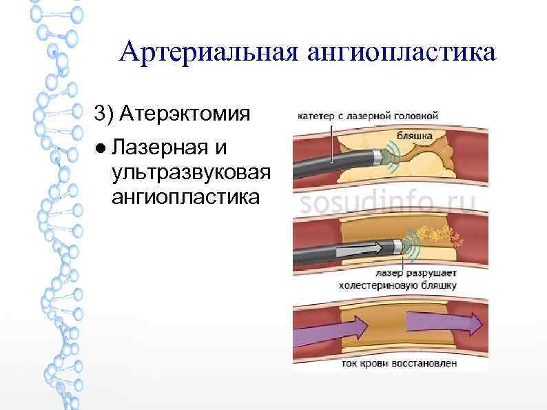 Артериальная ангиопластика 3) Атерэктомия ● Лазерная и ультразвуковая ангиопластика 