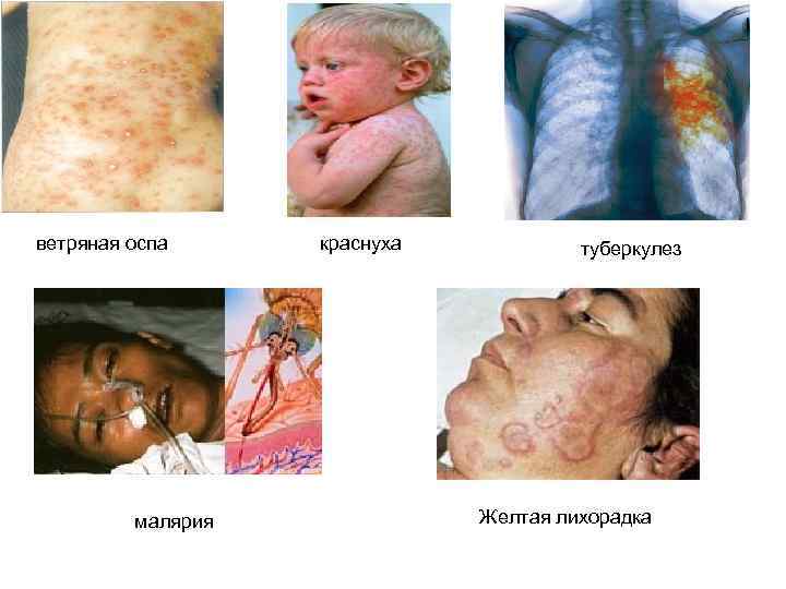 ветряная оспа малярия краснуха туберкулез Желтая лихорадка 