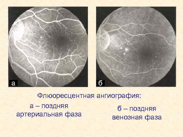 а б Флюоресцентная ангиография: а – поздняя б – поздняя артериальная фаза венозная фаза