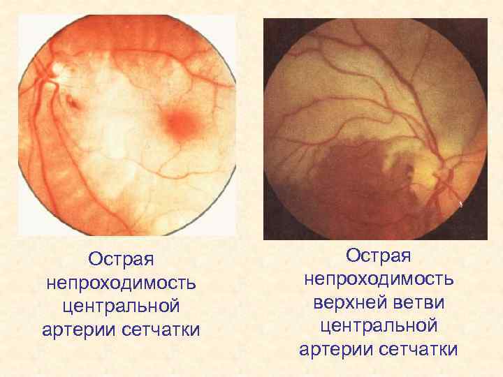 Острая непроходимость центральной артерии сетчатки Острая непроходимость верхней ветви центральной артерии сетчатки 