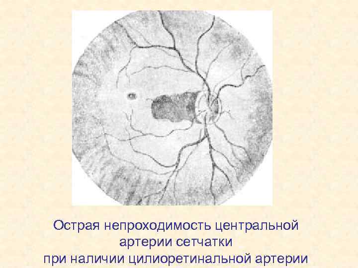 Острая непроходимость центральной артерии сетчатки при наличии цилиоретинальной артерии 