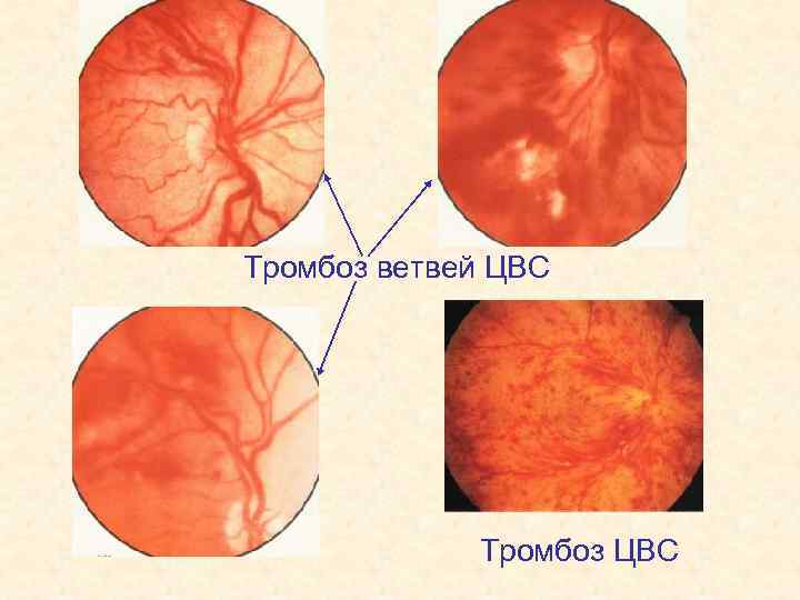 Тромбоз ветвей ЦВС Тромбоз ЦВС 