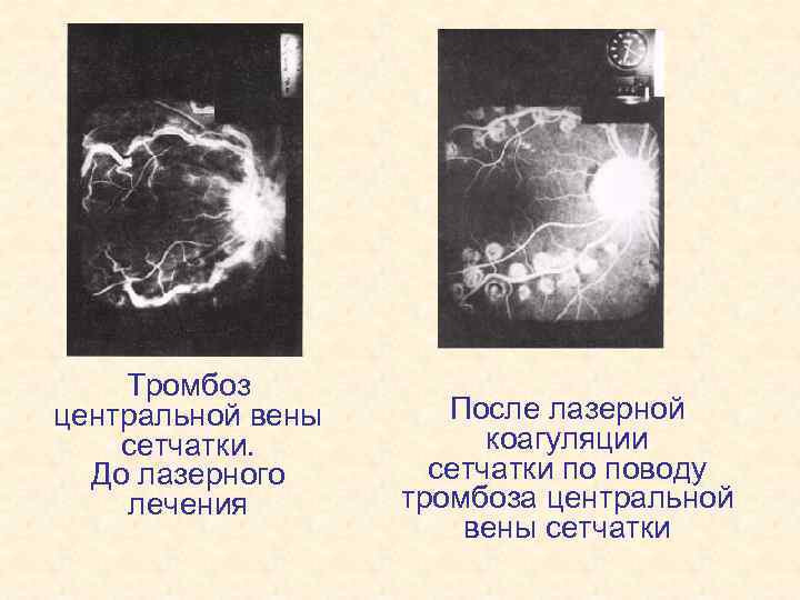 Тромбоз центральной вены сетчатки. До лазерного лечения После лазерной коагуляции сетчатки по поводу тромбоза