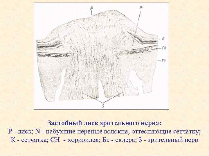 Застойный диск зрительного нерва: Р - диск; N - набухшие нервные волокна, оттесняющие сетчатку;