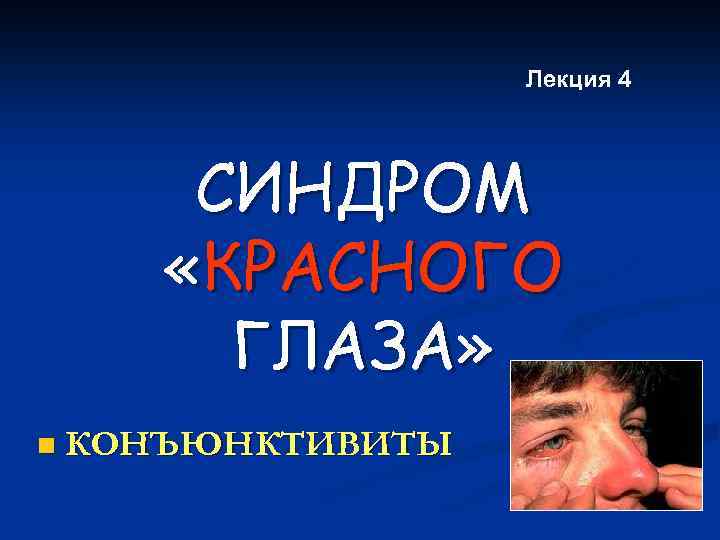 Лекция 4 СИНДРОМ «КРАСНОГО ГЛАЗА» n КОНЪЮНКТИВИТЫ 