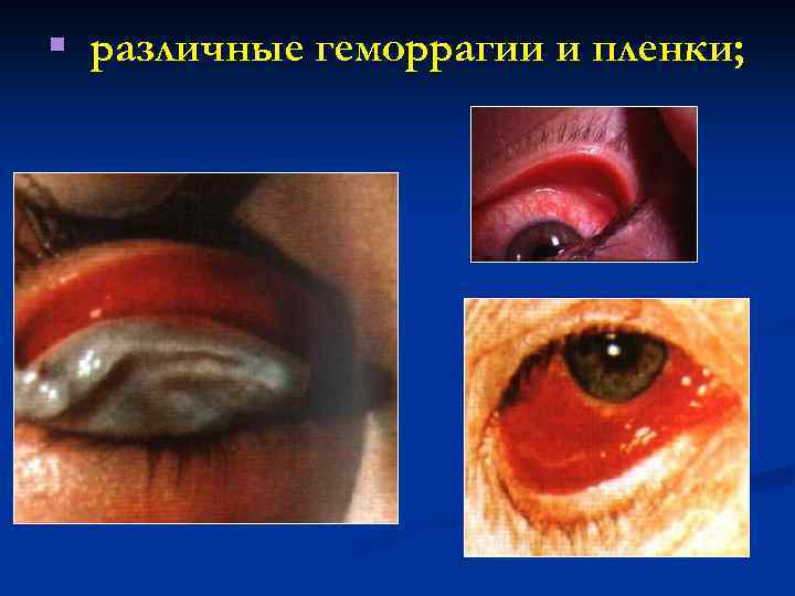 § различные геморрагии и пленки; 