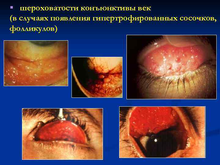 § шероховатости конъюнктивы век (в случаях появления гипертрофированных сосочков, фолликулов) 