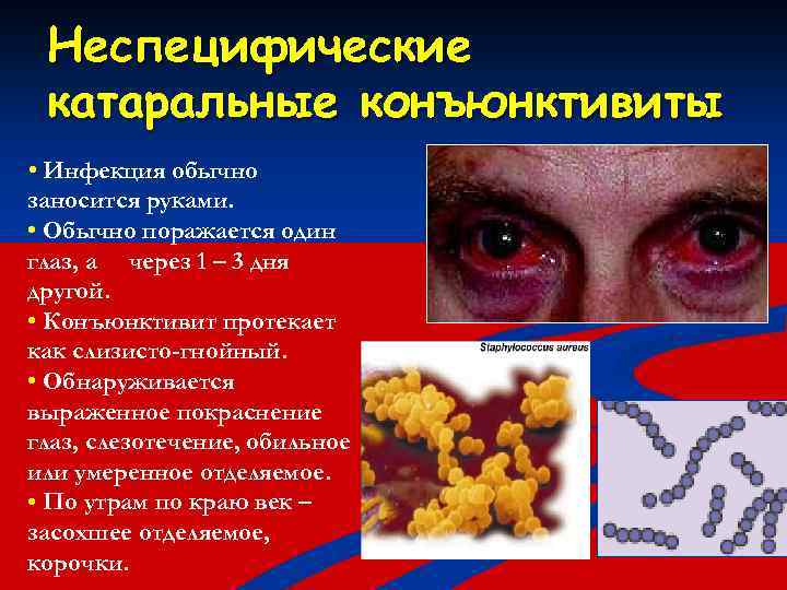 Неспецифические катаральные конъюнктивиты • Инфекция обычно заносится руками. • Обычно поражается один глаз, а