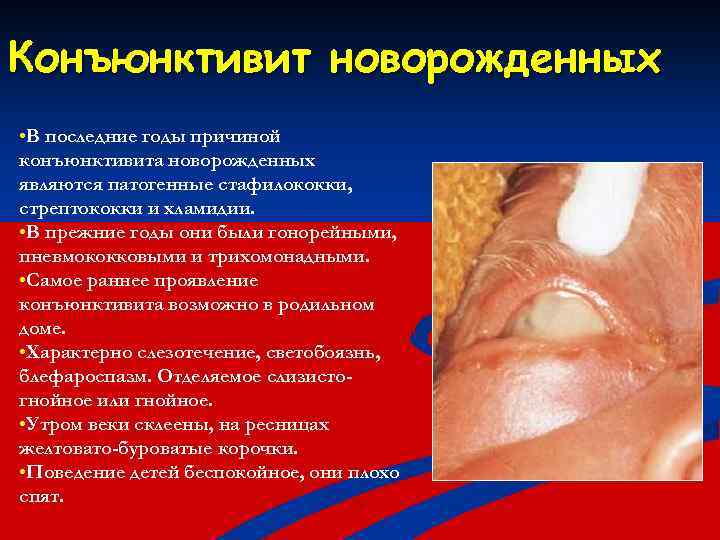 Конъюнктивит новорожденных • В последние годы причиной конъюнктивита новорожденных являются патогенные стафилококки, стрептококки и