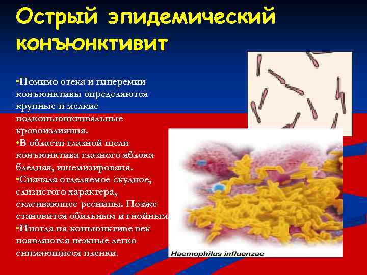 Острый эпидемический конъюнктивит • Помимо отека и гиперемии конъюнктивы определяются крупные и мелкие подконъюнктивальные