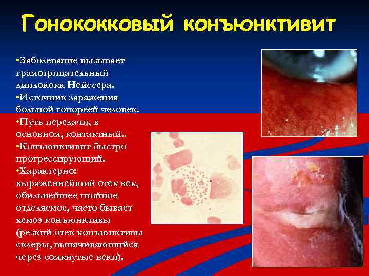 Гонококковый конъюнктивит • Заболевание вызывает грамотрицательный диплококк Нейссера. • Источник заражения больной гонореей человек.