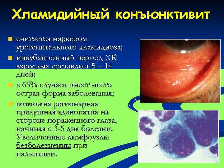 Хламидийный конъюнктивит n n считается маркером урогенитального хламидиоза; инкубационный период ХК взрослых составляет 5