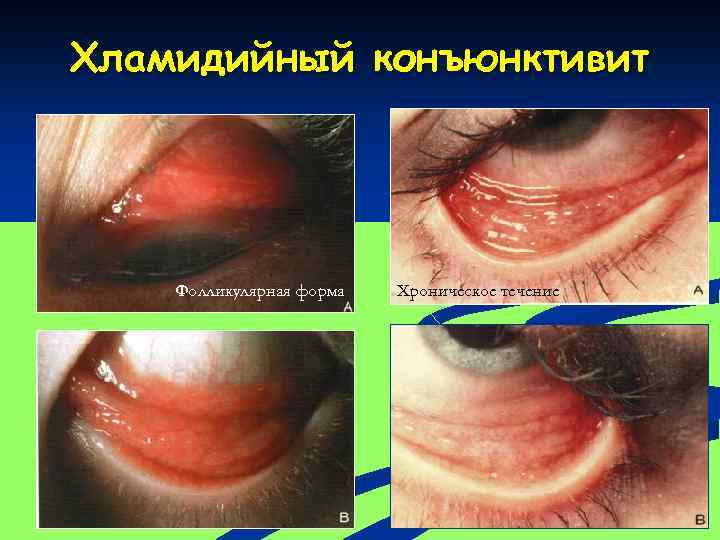 Хламидийный конъюнктивит Фолликулярная форма Хроническое течение 