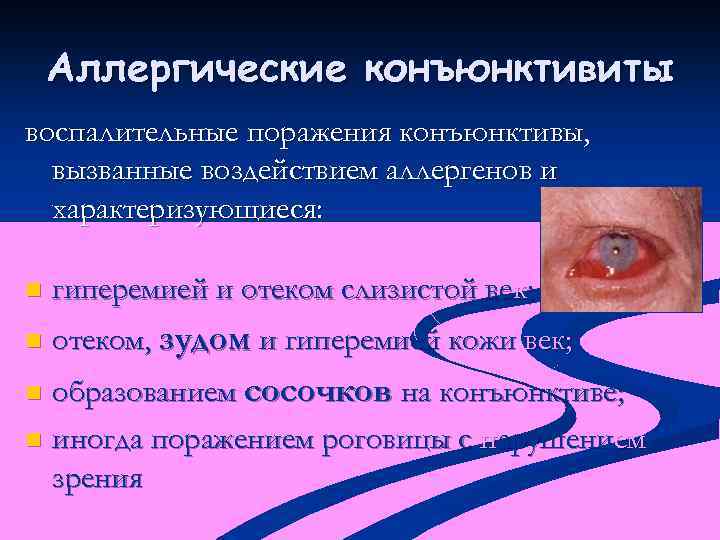 Аллергические конъюнктивиты воспалительные поражения конъюнктивы, вызванные воздействием аллергенов и характеризующиеся: n гиперемией и отеком