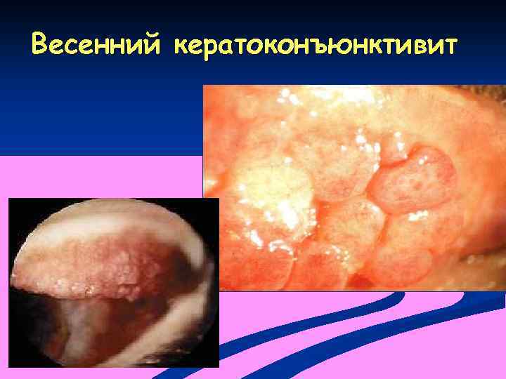 Весенний кератоконъюнктивит 