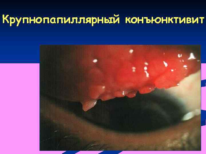 Крупнопапиллярный конъюнктивит 