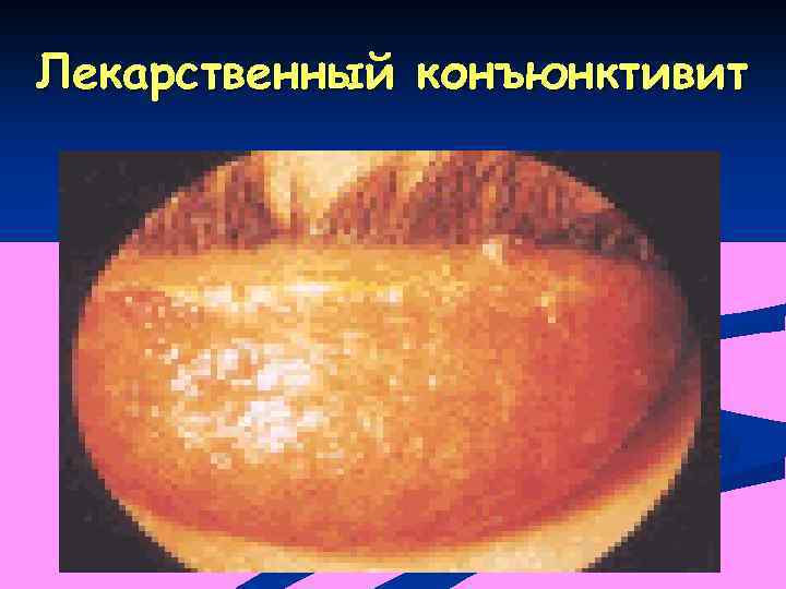 Лекарственный конъюнктивит 