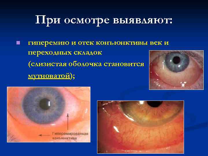 При осмотре выявляют: n гиперемию и отек конъюнктивы век и переходных складок (слизистая оболочка