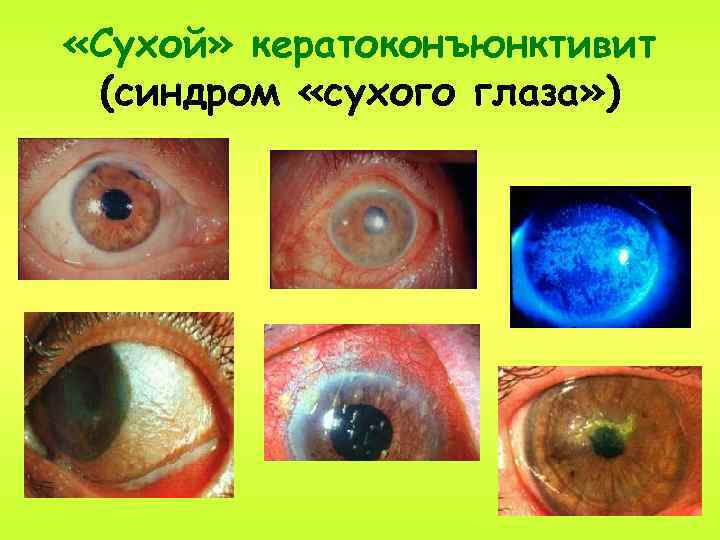  «Сухой» кератоконъюнктивит (синдром «сухого глаза» ) 