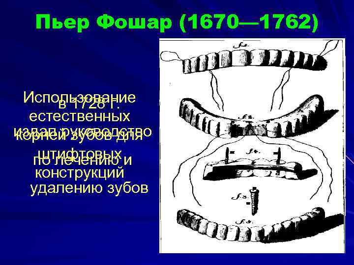  Пьер Фошар (1670— 1762) Использование в 1728 г. естественных издал руководство корней зубов