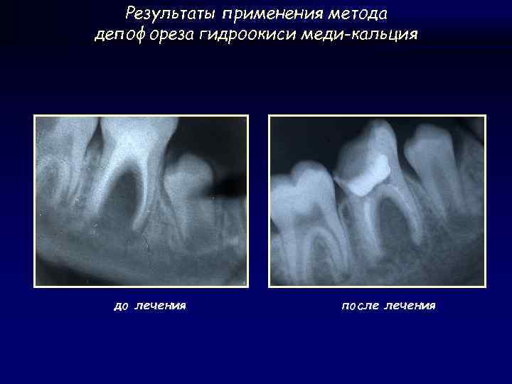 Результаты применения метода депофореза гидроокиси меди-кальция до лечения после лечения 