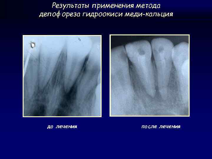 Результаты применения метода депофореза гидроокиси меди-кальция до лечения после лечения 