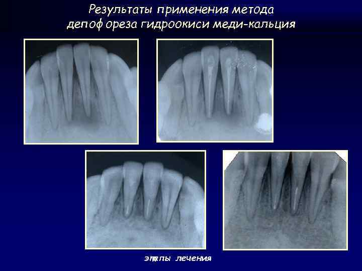 Результаты применения метода депофореза гидроокиси меди-кальция этапы лечения 