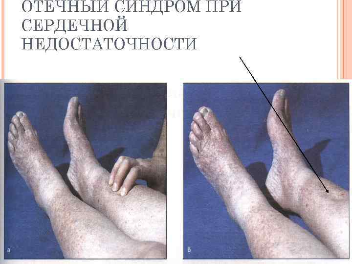 ОТЕЧНЫЙ СИНДРОМ ПРИ СЕРДЕЧНОЙ НЕДОСТАТОЧНОСТИ 