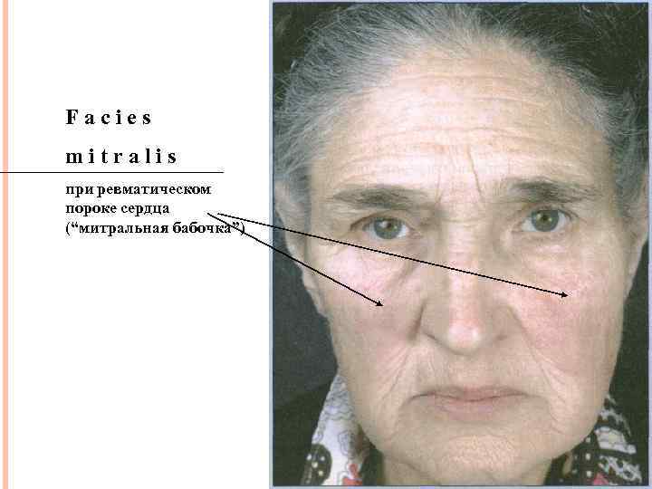 Facies mitralis при ревматическом пороке сердца (“митральная бабочка”) 