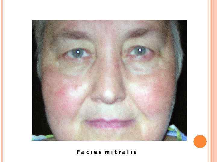 ((р. 3. 80) Facies mitralis 