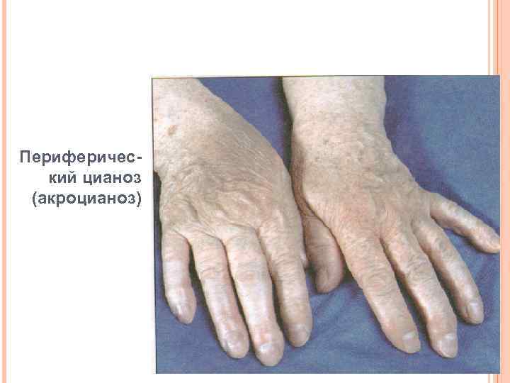 Периферический цианоз (акроцианоз) 