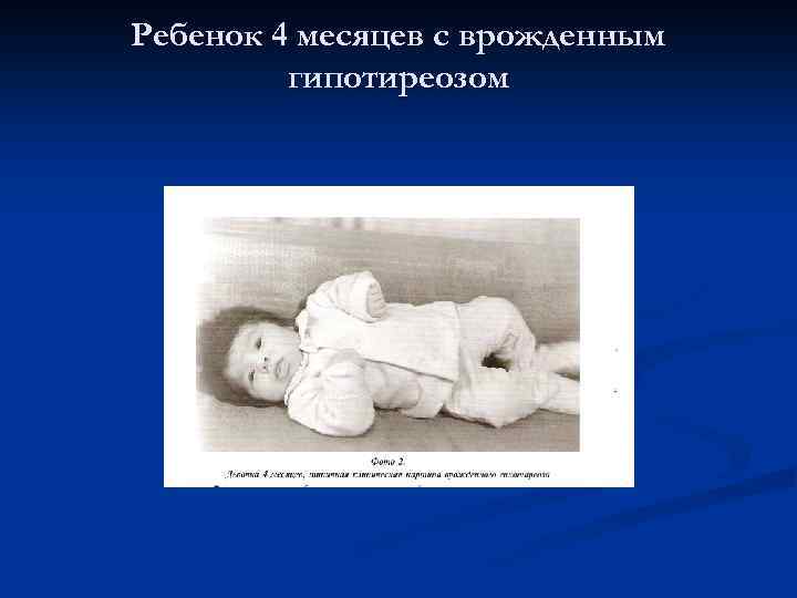 Ребенок 4 месяцев с врожденным гипотиреозом 