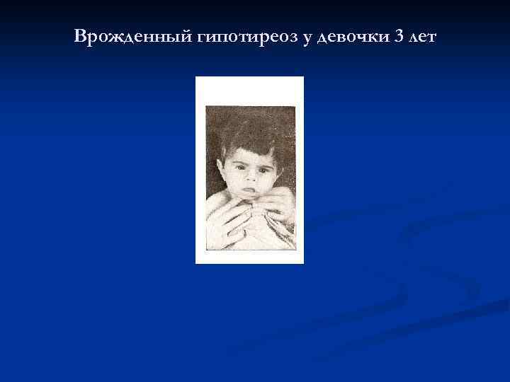 Врожденный гипотиреоз у девочки 3 лет 