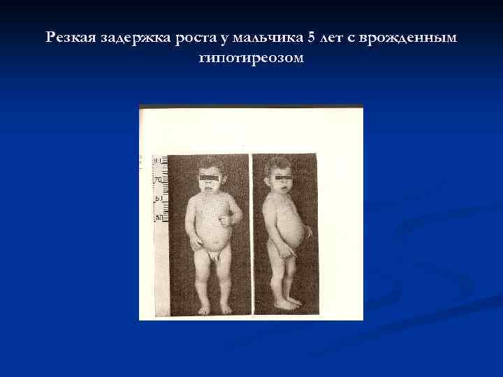 Резкая задержка роста у мальчика 5 лет с врожденным гипотиреозом 