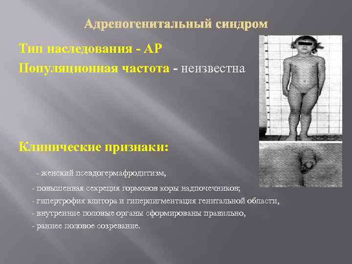 Тип наследования - АР Популяционная частота - неизвестна Клинические признаки: - женский псевдогермафродитизм, -