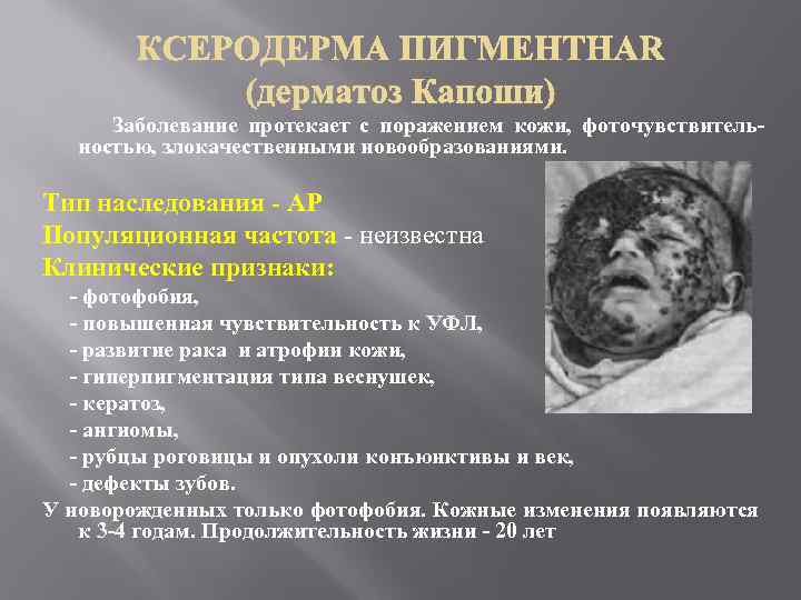 Заболевание протекает с поражением кожи, фоточувствительностью, злокачественными новообразованиями. Тип наследования - АР Популяционная
