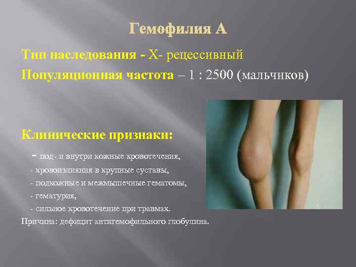 Тип наследования - Х- рецессивный Популяционная частота – 1 : 2500 (мальчиков) Клинические признаки: