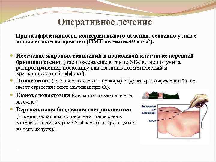 Оперативное лечение При неэффективности консервативного лечения, особенно у лиц с выраженным ожирением (ИМТ не