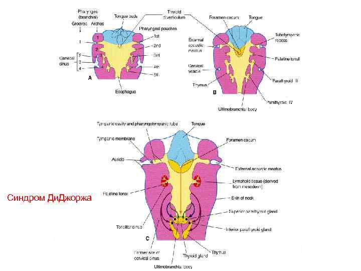Синдром Ди. Джоржа 