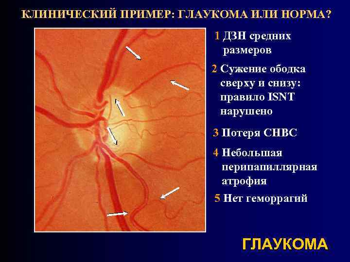 Зрительный нерв при глаукоме