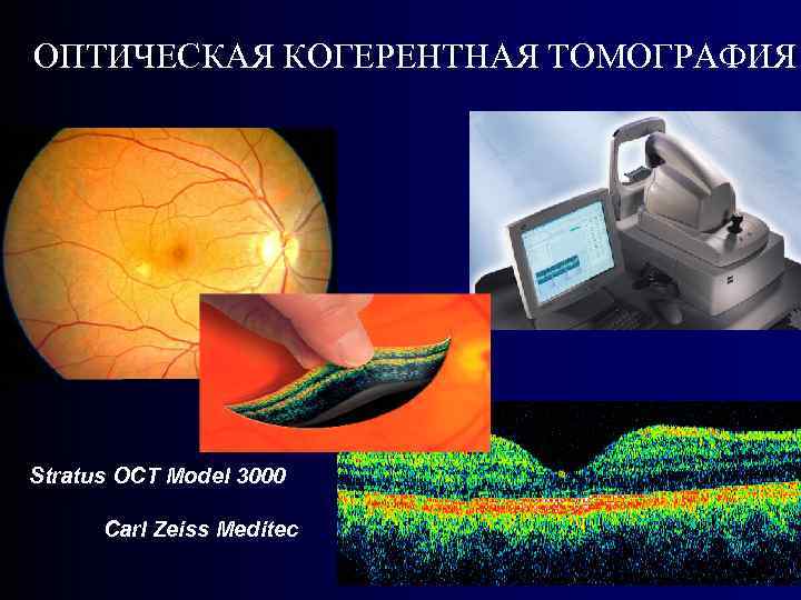 ОПТИЧЕСКАЯ КОГЕРЕНТНАЯ ТОМОГРАФИЯ Stratus OCT Model 3000 Carl Zeiss Meditec 