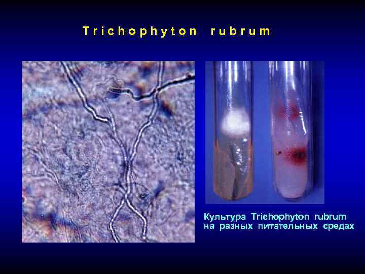 Trichophyton rubrum Культура Trichophyton rubrum на разных питательных средах 