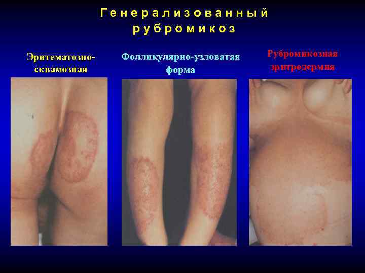 Генерализованный рубромикоз Эритематозносквамозная форма Фолликулярно-узловатая форма Рубромикозная эритродермия 