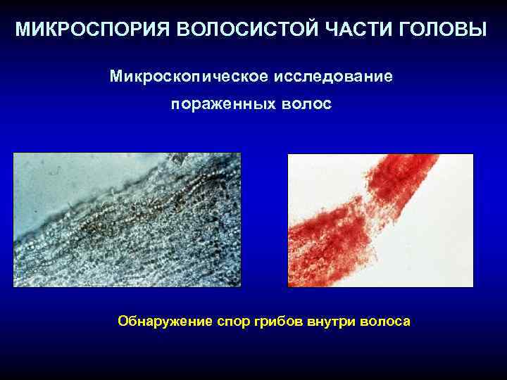 МИКРОСПОРИЯ ВОЛОСИСТОЙ ЧАСТИ ГОЛОВЫ Микроскопическое исследование пораженных волос Обнаружение спор грибов внутри волоса 